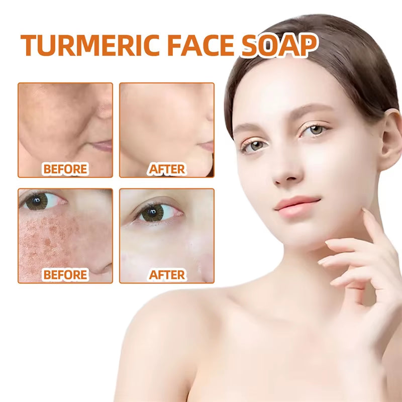 Kojic Acid Soap Handmade Whitening Soap Brightening Skin Lighten Dark Spot Turmeric Soap Acne Scare Removal Cleaning Skin