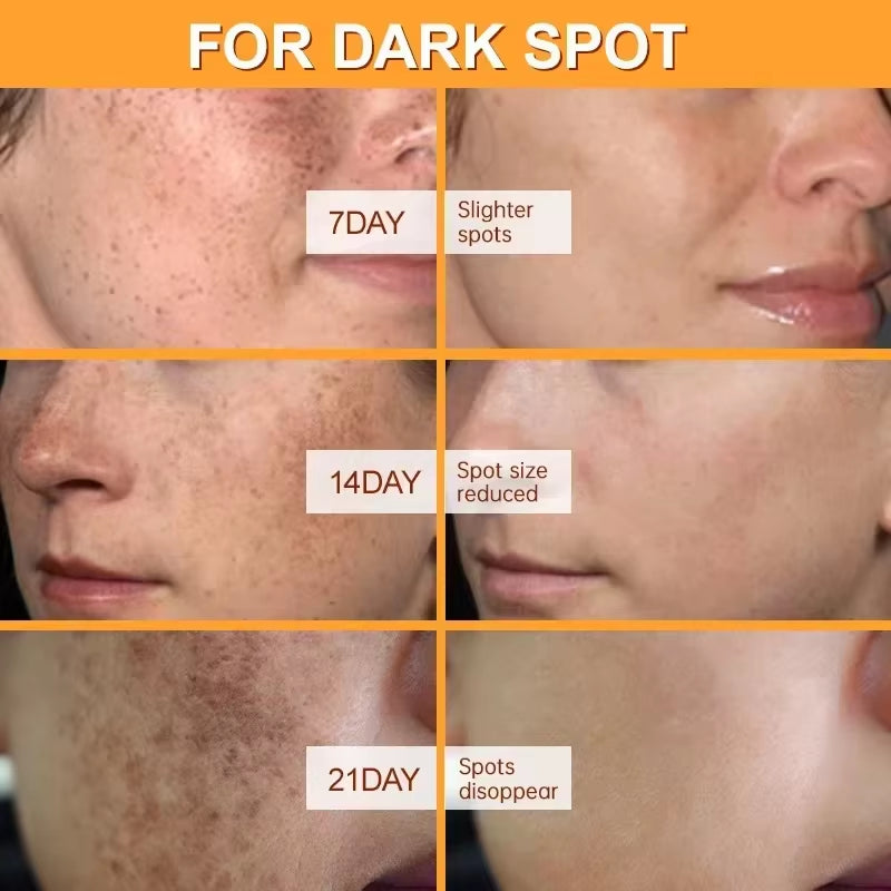 Effective Whitening Freckles Face Cream Remove Melasma Dark Spots Fade Pigmentation Acne Scars Moisturizing Brighten Beauty Care