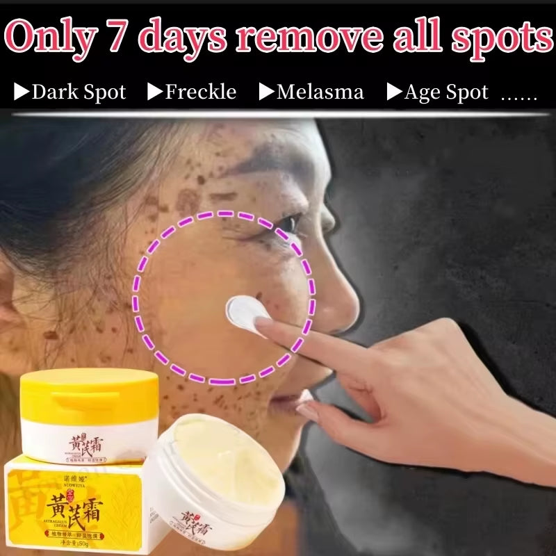 Effective Whitening Freckles Face Cream Remove Melasma Dark Spots Fade Pigmentation Acne Scars Moisturizing Brighten Beauty Care